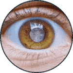 Cirurgia de Catarata